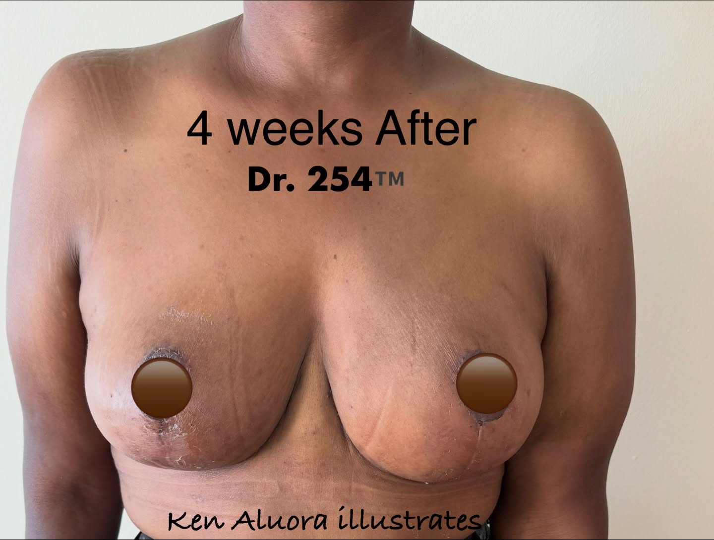 Before Breast Lift