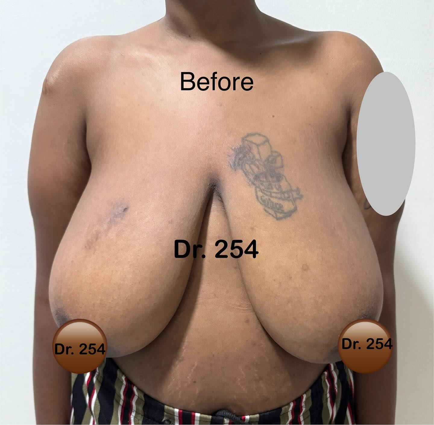 After Breast Reduction