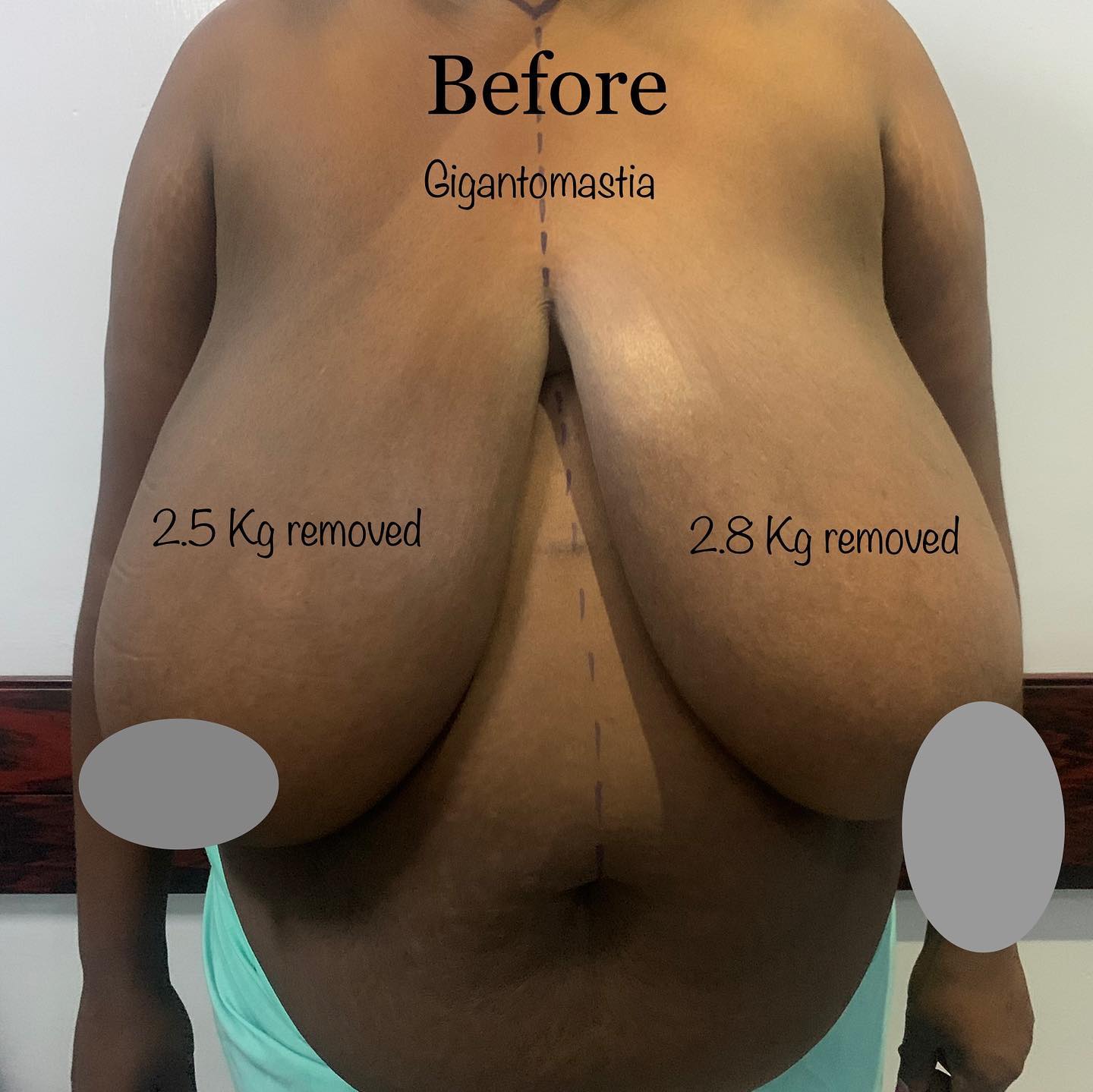 Before Gigantomastia
