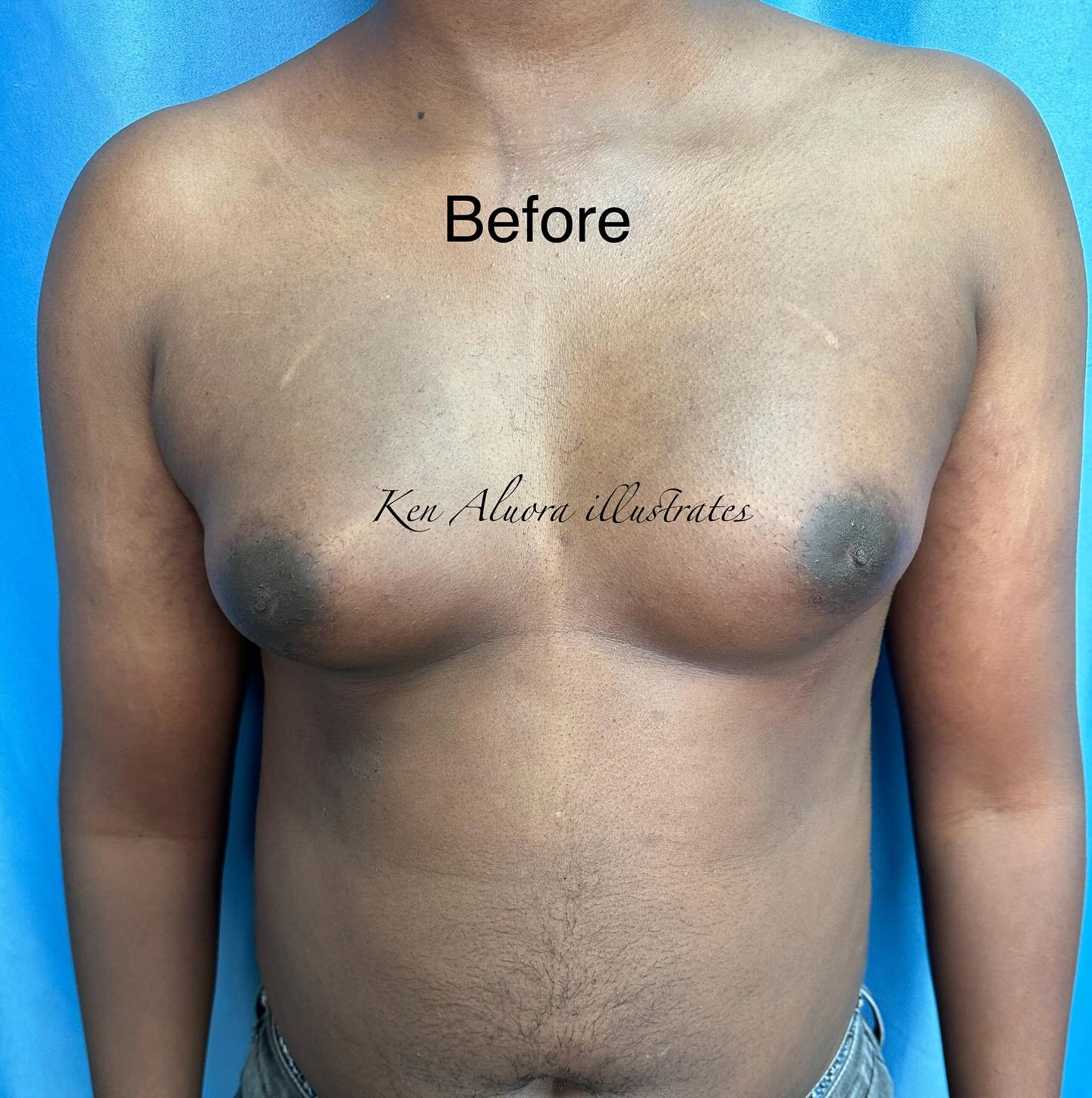 Before Gynaecomastia Surgery