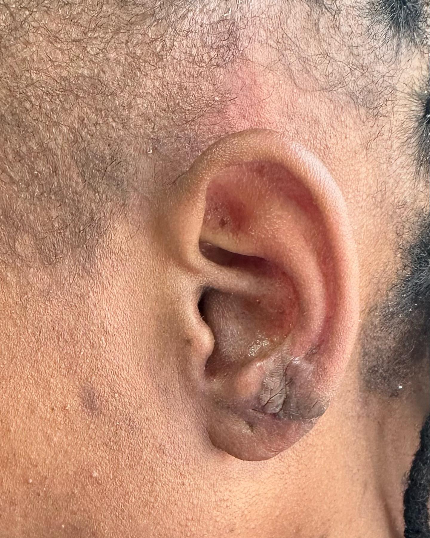 Before Keloid Excision