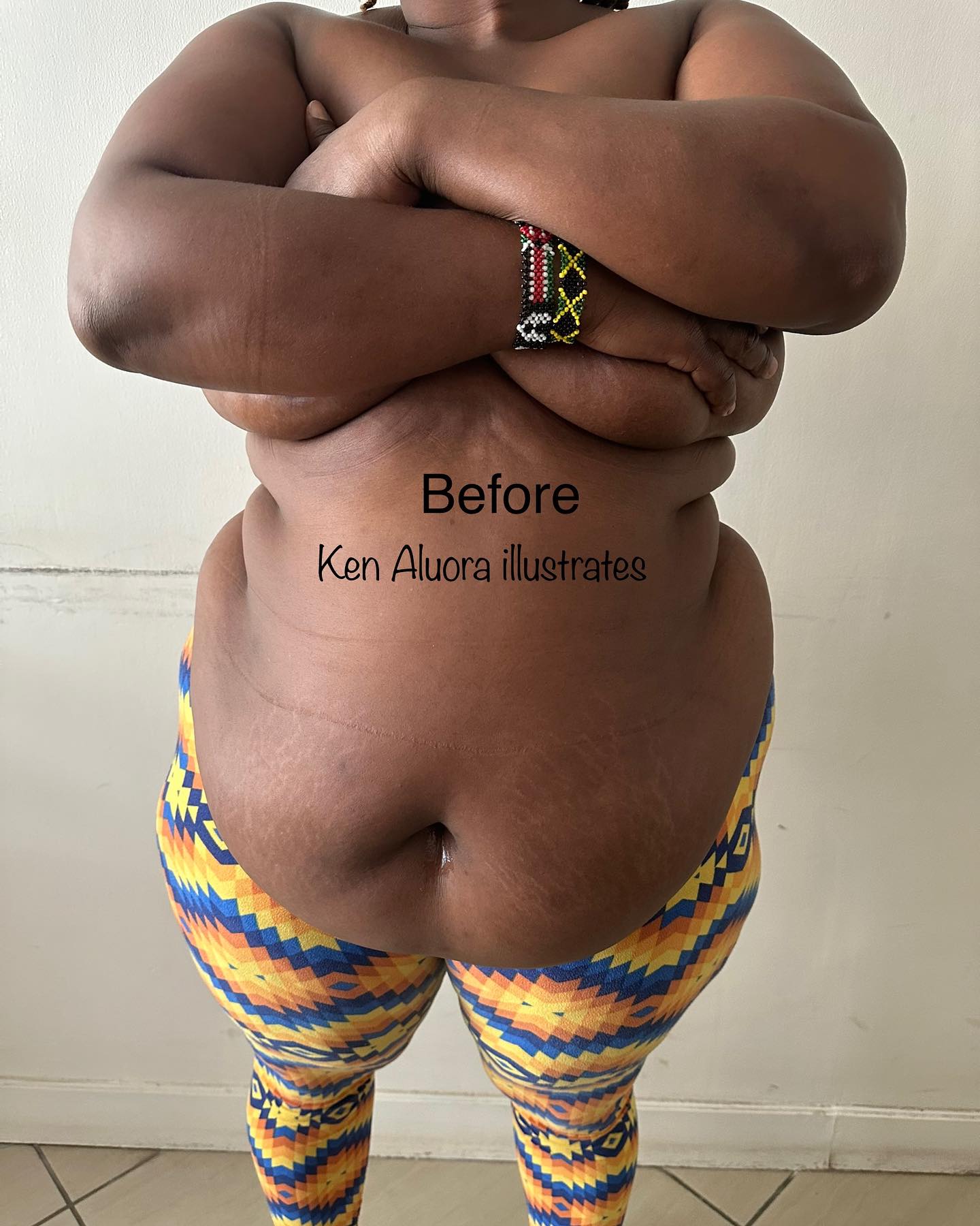 Before Tummy Tuck