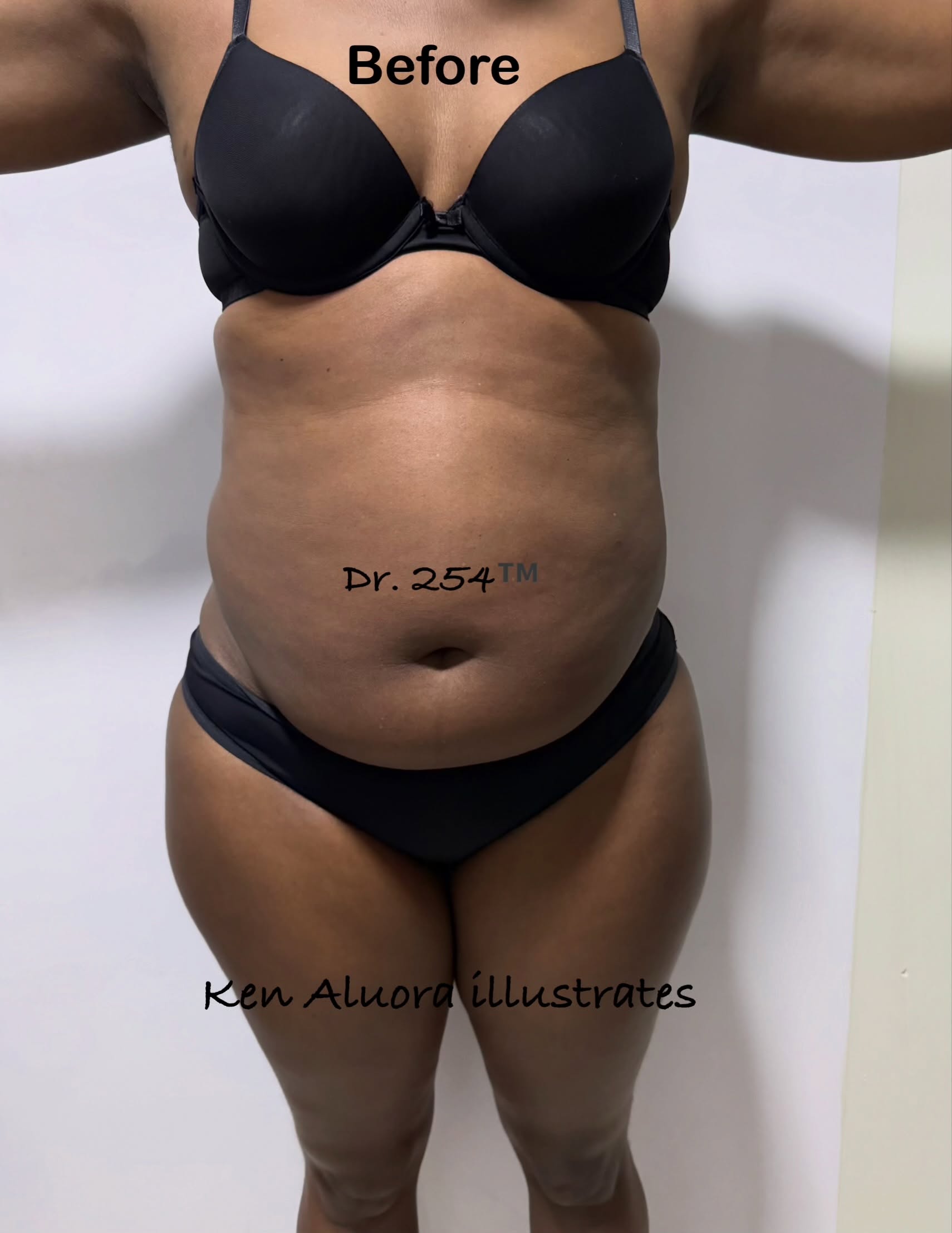 Before Tummy Tuck
